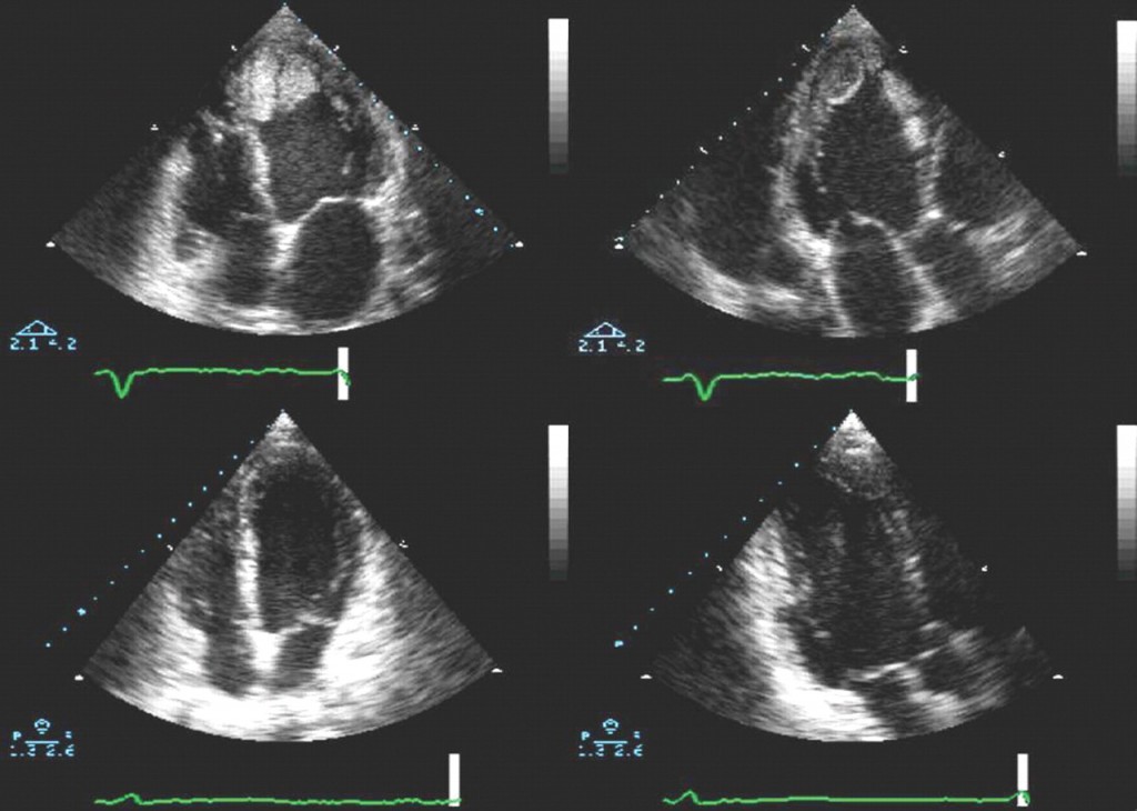 來源: European Heart Journal