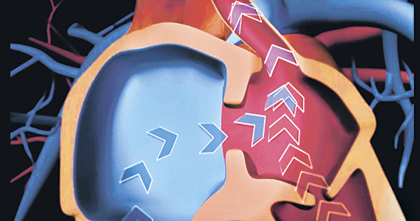 ▲心房間隔缺損是左心房及右心房之間出現一個或多個洞，以致缺氧血有機會混和帶氧血，令血含氧量下降。