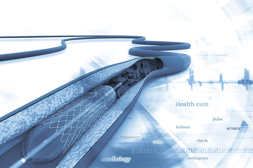 ▼通波仔手術若用了藥性支架，病人的血管內層會在6個月至1年內，生長新的細胞來覆蓋支架。（網上圖片）