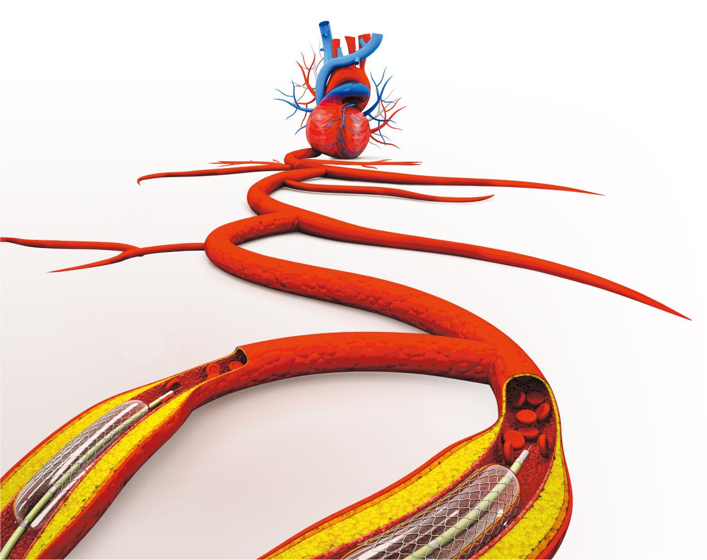 圖3之1 - 撐起血管——當心血管收窄超過百分之五十，以及出現缺血情况或嚴重徵狀，就需要考慮通波仔。但單靠球囊擴張血管，取走球囊後血管會再次收窄，因此建議植入支架，撐起血管壁邊，維持血流暢通。（圖：HYWARDS@iStockphoto