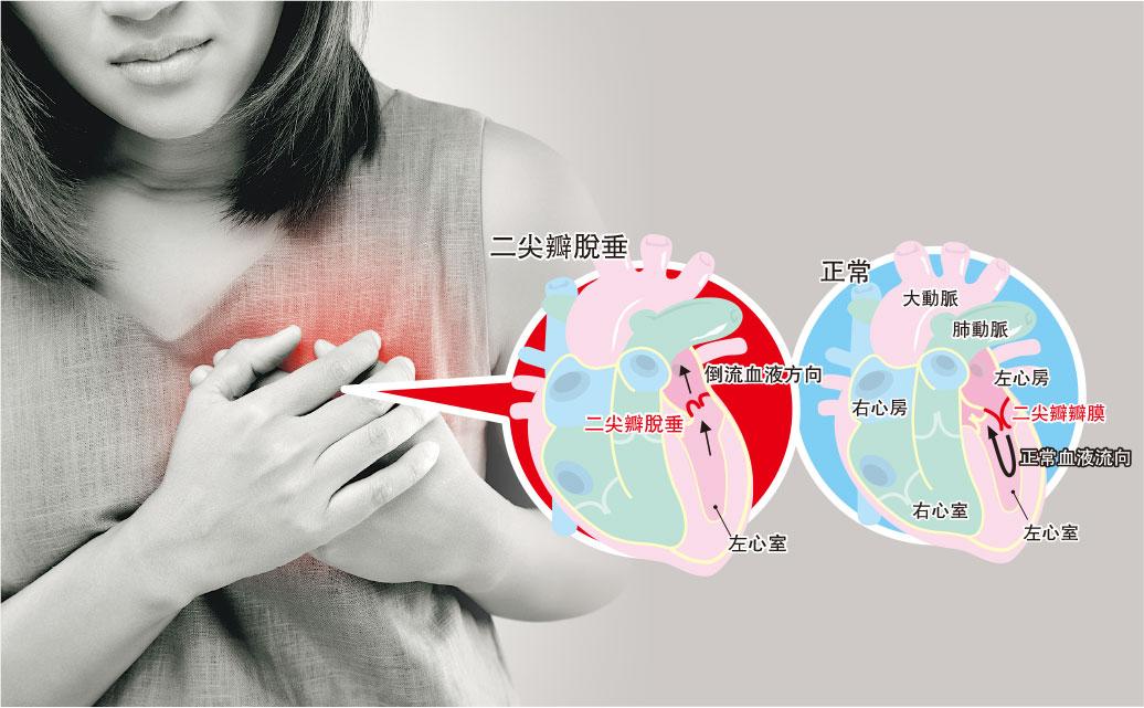 血液倒流——正常的二尖瓣膜在血液自左心房泵出左心室後,可以完全閉合(右圖),但如出現脫垂問題,血液就會倒流左心房(左圖),長遠會加重心臟負擔,造成心衰竭。(圖:Tharakorn@iStockphoto)