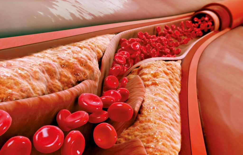 你的壞膽固醇復常了嗎？